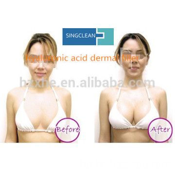 Dermal filler manufacturer Hyaluronic acid Filler injection for breast enhancement